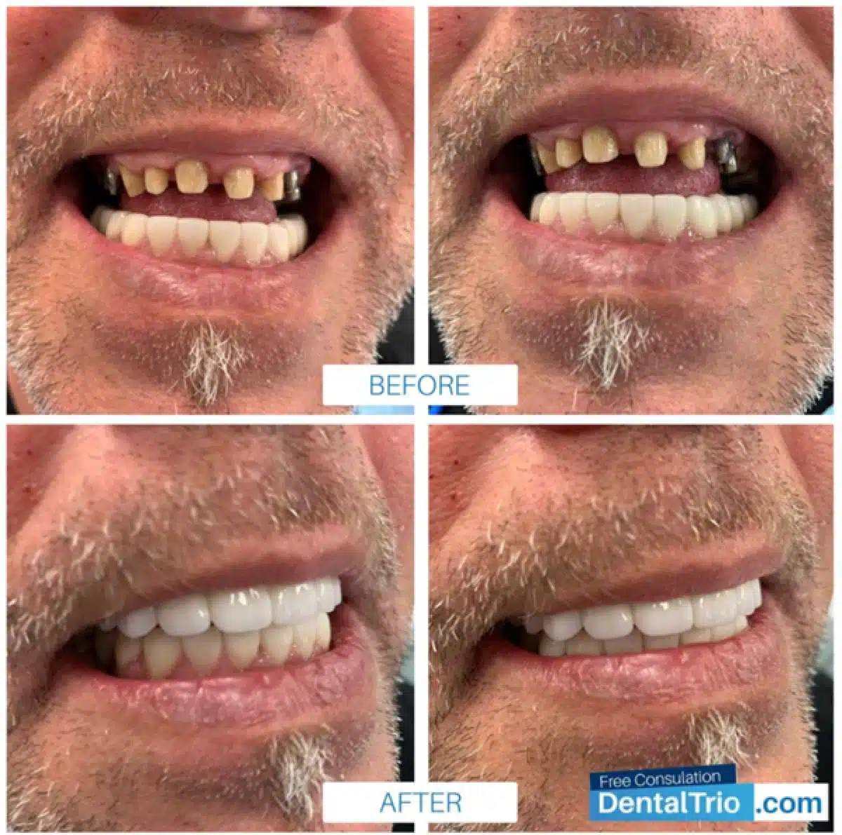 Gli impianti dentali in Albania sono una buona decisione? - impianti dentali Albania - Look Out News